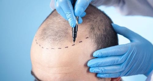 The Quiet Destigmatization of the Hair Transplant